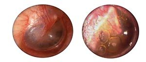 Barotrauma de grado 1